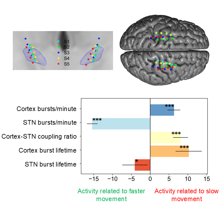 A figure showing electrode contact placements on a brain scan from the side, and from above. Below is a bar chart showing the summary results of the paper.