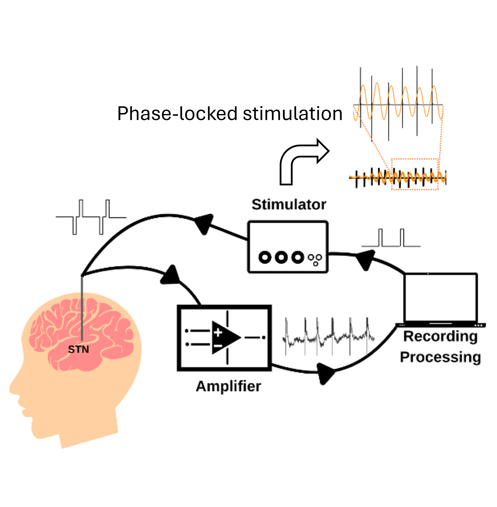 The phase-locked deep brain stimulation system delivers electrical pulses to the subthalamic nucleus by targeting specific phases of brain oscillations.
