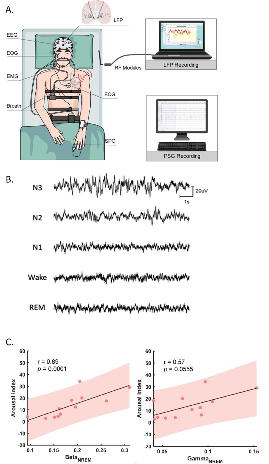 The image shows the recording system, example waveforms local field potential (LFP) signals for different sleep stages, and the correlation between the severity of sleep fragmentation and LFP oscillations in the subthalamic nucleus.