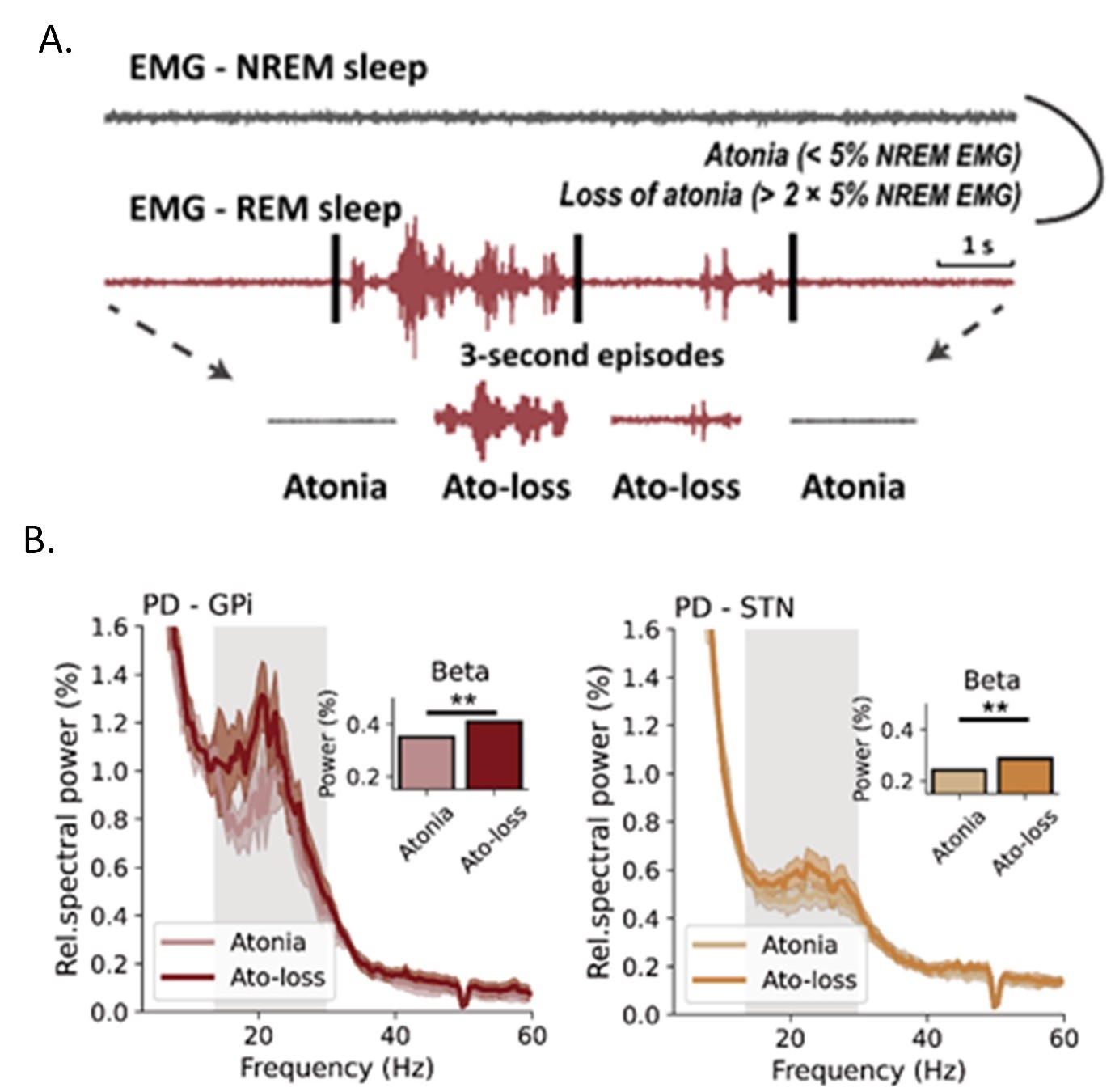 Plot A of this figure shows how rapid eye movement (REM) sleep with/without atonia is determined by EMG measurement. Plot B of this figure shows basal ganglia beta power during REM sleep increased during the time period with loss of atonia compared with atonia.