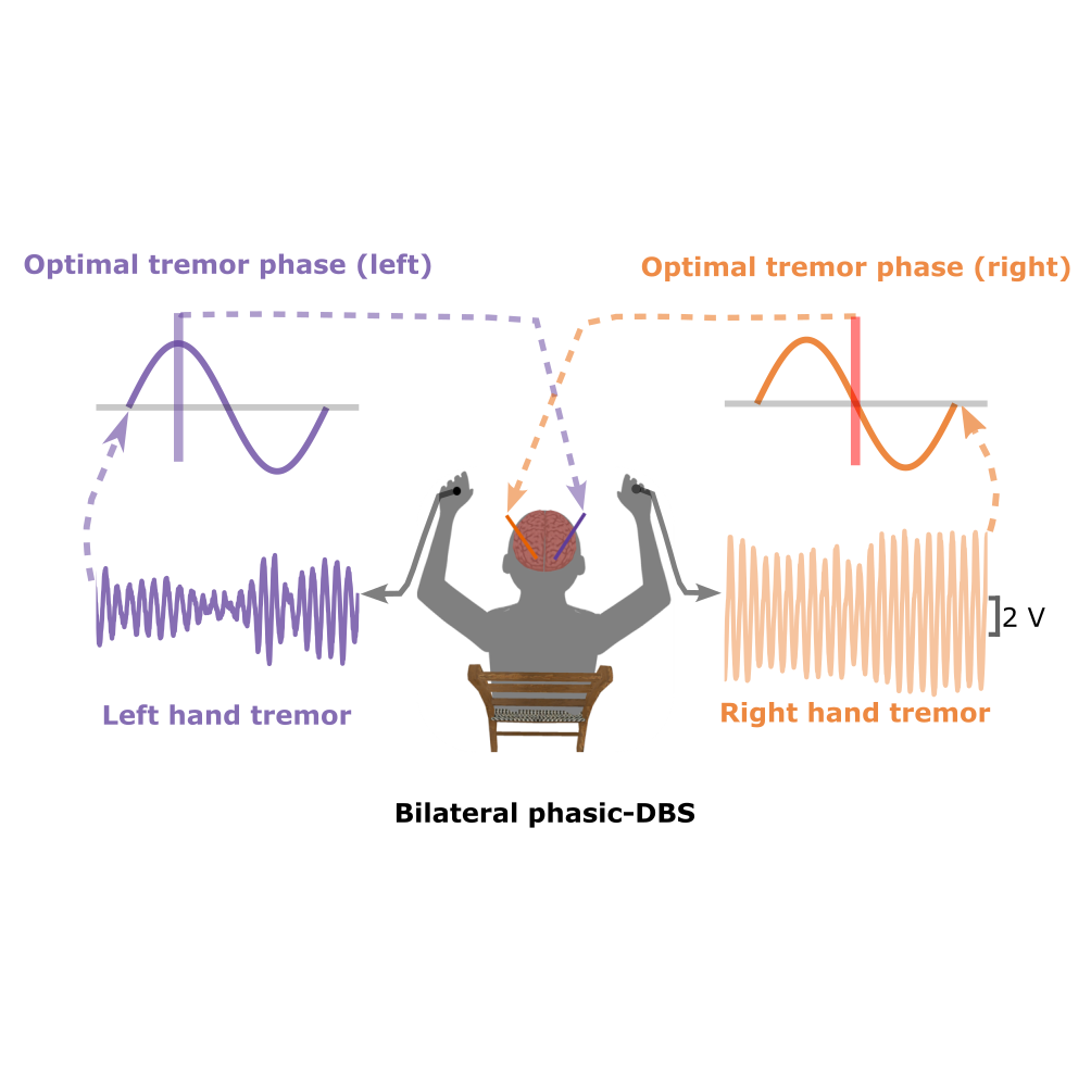 Bilateral tremor phase-locked deep brain stimulation (DBS).