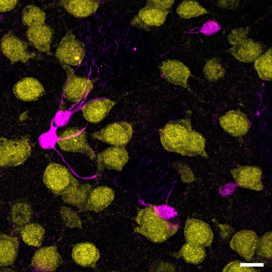 Image of pseudocoloured cells in a tissue section from mouse brain. Yellow cells are neurons. Pink cells are astrocytes.