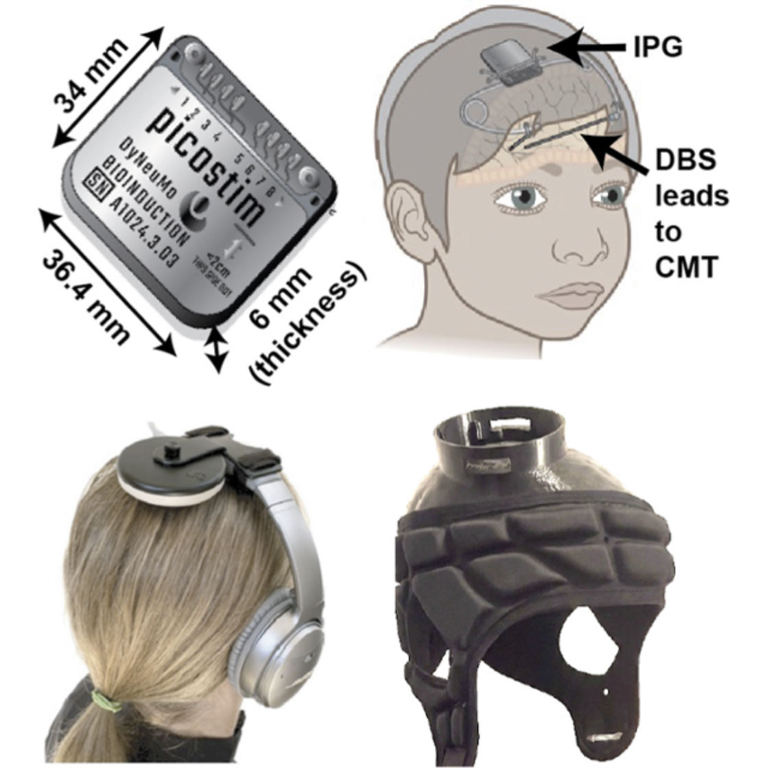 diagram with four parts: the picostim unit; where the picostim sits in a pocket in the cranium; how the unit is charged via headphones, and a cap with aligned pocket over the implant