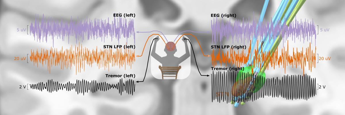 diagram showing a human subject in the middle, with arms out, and recordings from their brain and tremor recordings from their arms, displayed as traces on either side