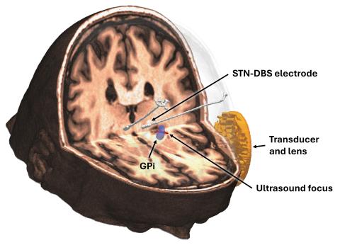 GPi-targeted transcranial ultrasound stimulation in STN-DBS patients.