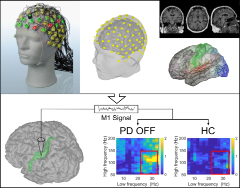 This study measured brain signals in patients and healthy individuals using EEG combined with MRI-based source localisation techniques to study abnormal coupling across the motor network and its modulation by levodopa in Parkinson’s disease. 