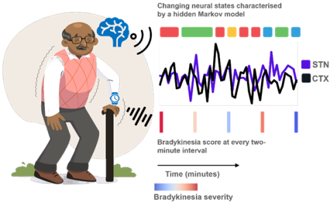 cartoon image of a person with Parkinson's on left, with a plot of brainwaves, and classification of neural states on right.