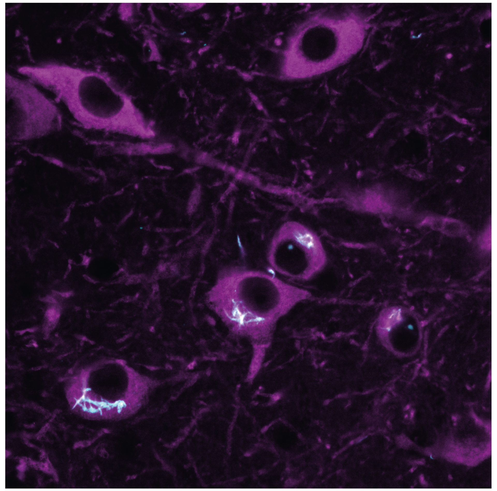 micrograph showing purple cells- fired-egg-like appearance with dark centres where the nucleus is. Clumps of spikey-looking material is showing in cyan, inside the cells.